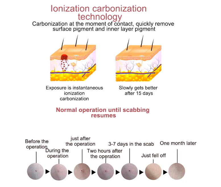 Pluma para Eliminar Lunares  Set of 3 - Unisex - Talla Única (One Size)