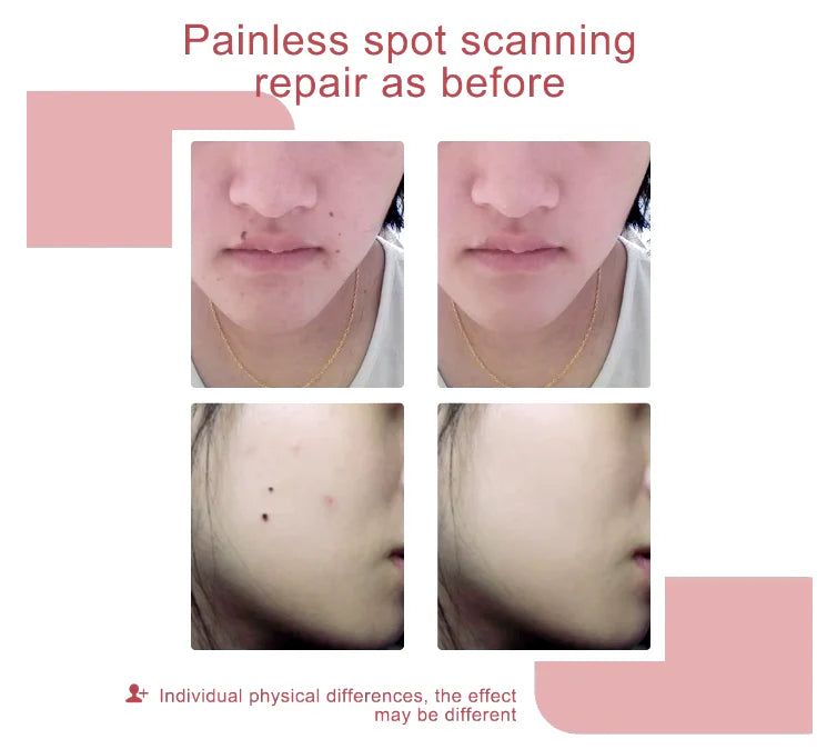 Pluma para Eliminar Lunares  Set of 3 - Unisex - Talla Única (One Size)